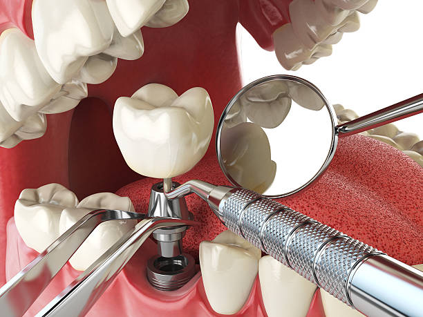Best Emergency Broken Tooth Repair in Beverly, OH