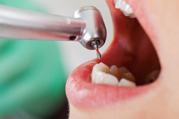 Best Emergency Wisdom Teeth Removal in Beverly, OH